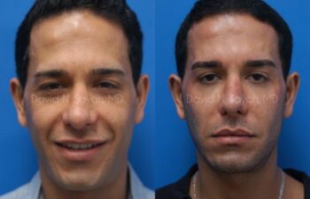 Eyelid Surgery Before and After | Sayah Institute