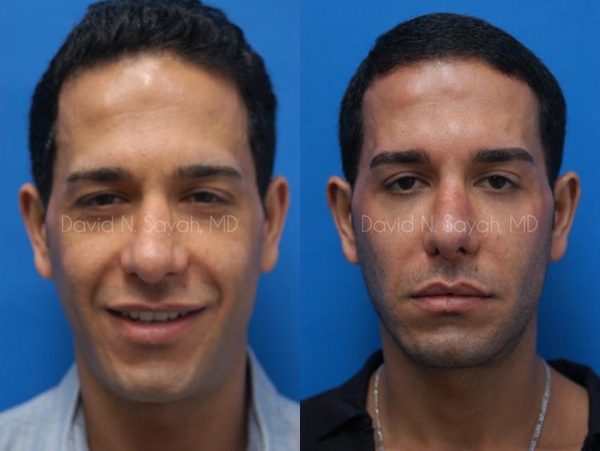 Eyelid Surgery Before and After | Sayah Institute