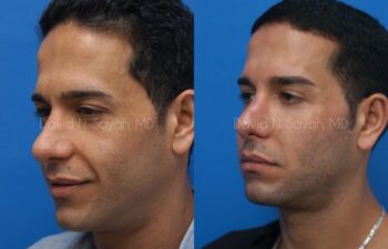 Eyelid Surgery Before and After | Sayah Institute