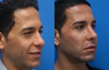 Eyelid Surgery Before and After | Sayah Institute
