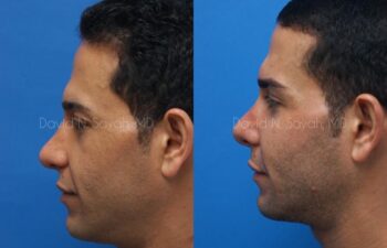 Eyelid Surgery Before and After | Sayah Institute