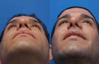 Eyelid Surgery Before and After | Sayah Institute