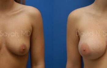Breast Augmentation Before and After | Sayah Institute