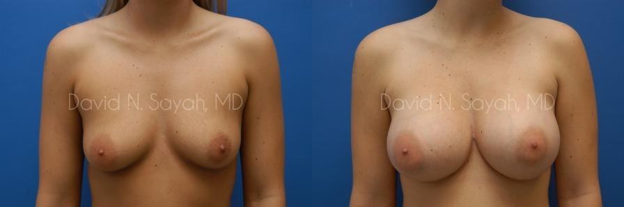 Breast Augmentation Before and After | Sayah Institute