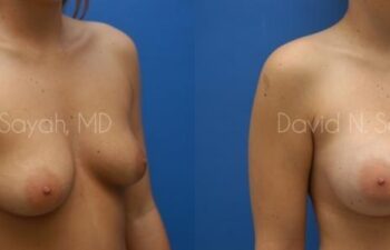 Breast Augmentation Before and After | Sayah Institute