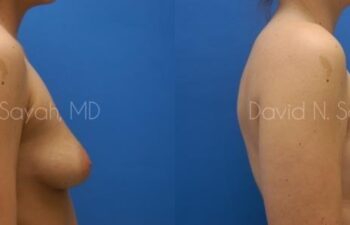 Breast Augmentation Before and After | Sayah Institute