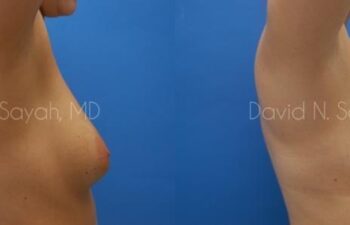 Breast Augmentation Before and After | Sayah Institute