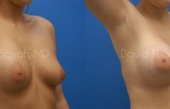 Breast Augmentation Before and After | Sayah Institute