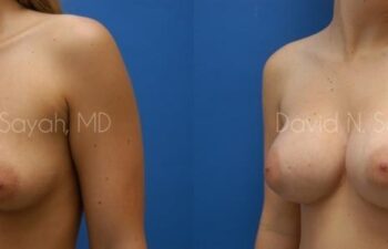 Breast Augmentation Before and After | Sayah Institute