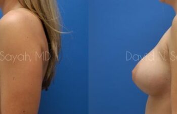 Breast Augmentation Before and After | Sayah Institute