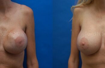 Breast Implant Revision Before and After | Sayah Institute