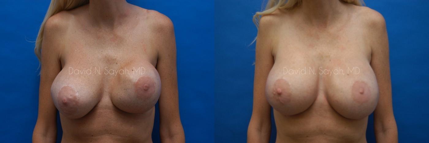 Breast Implant Revision Before and After | Sayah Institute