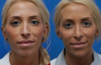 Rhinoplasty Before and After | Sayah Institute