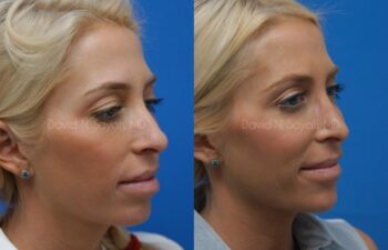 Rhinoplasty Before and After | Sayah Institute