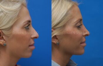 Rhinoplasty Before and After | Sayah Institute
