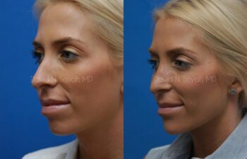 Rhinoplasty Before and After | Sayah Institute