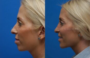 Rhinoplasty Before and After | Sayah Institute