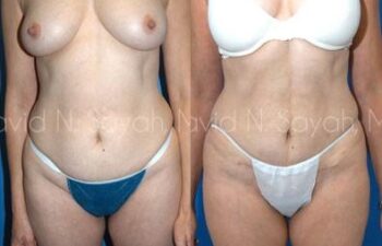 Tummy Tuck Before and After | Sayah Institute
