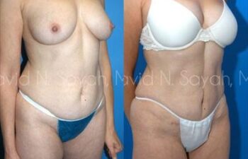 Tummy Tuck Before and After | Sayah Institute