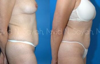 Tummy Tuck Before and After | Sayah Institute