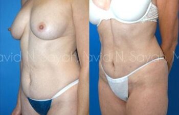Tummy Tuck Before and After | Sayah Institute