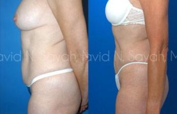Tummy Tuck Before and After | Sayah Institute