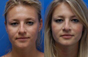 Rhinoplasty Before and After | Sayah Institute