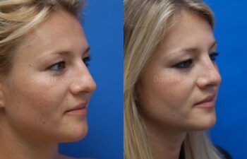 Rhinoplasty Before and After | Sayah Institute