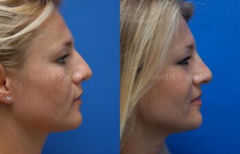 Rhinoplasty Before and After | Sayah Institute