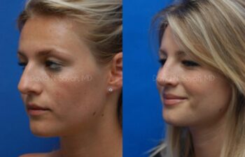 Rhinoplasty Before and After | Sayah Institute