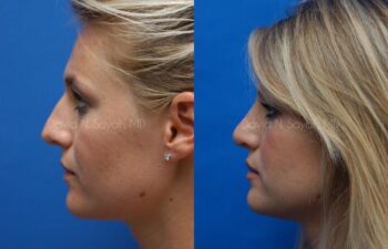 Rhinoplasty Before and After | Sayah Institute