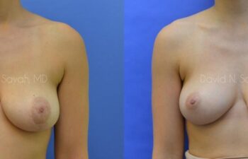 Breast Reconstruction Before and After | Sayah Institute