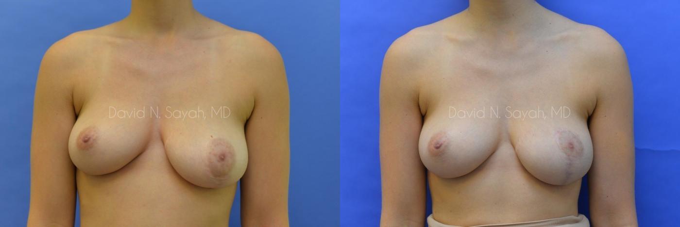Breast Reconstruction Before and After | Sayah Institute
