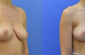 Breast Reconstruction Before and After | Sayah Institute