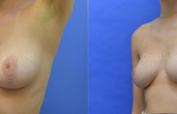 Breast Reconstruction Before and After | Sayah Institute