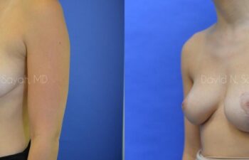 Breast Reconstruction Before and After | Sayah Institute