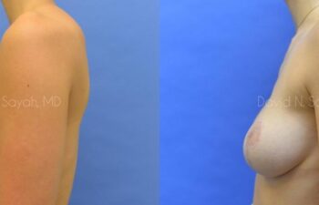 Breast Reconstruction Before and After | Sayah Institute
