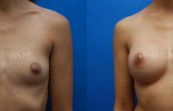Breast Augmentation Before and After | Sayah Institute