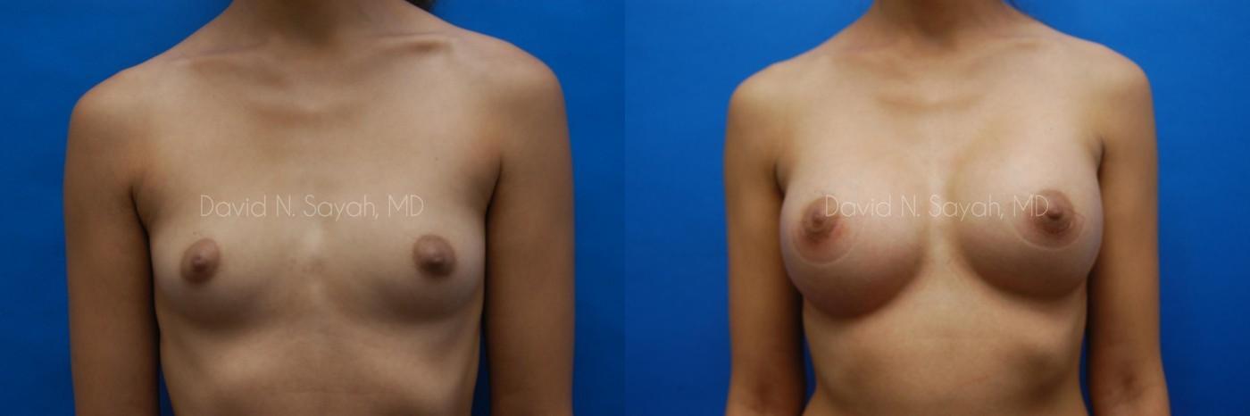Breast Augmentation Before and After | Sayah Institute