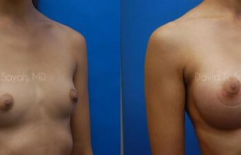 Breast Augmentation Before and After | Sayah Institute