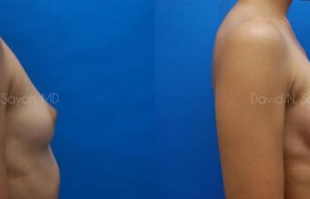 Breast Augmentation Before and After | Sayah Institute