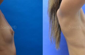 Breast Augmentation Before and After | Sayah Institute
