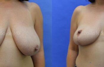 Breast Reduction Before and After | Sayah Institute
