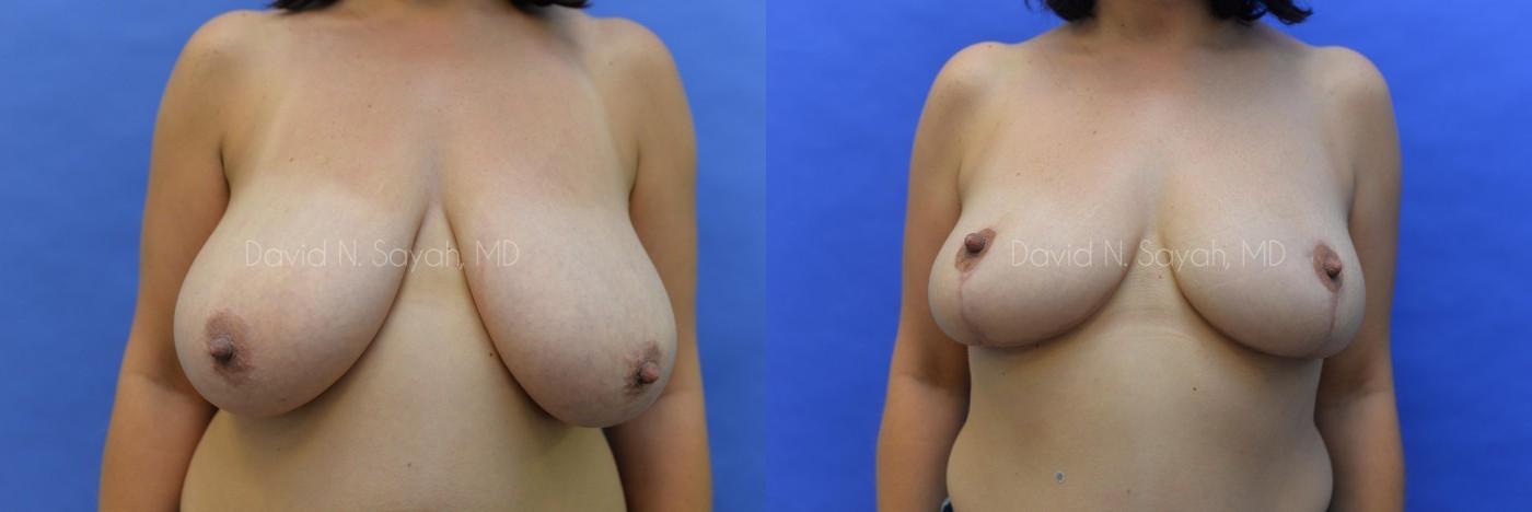 Breast Reduction Before and After | Sayah Institute