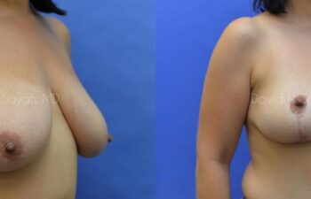 Breast Reduction Before and After | Sayah Institute