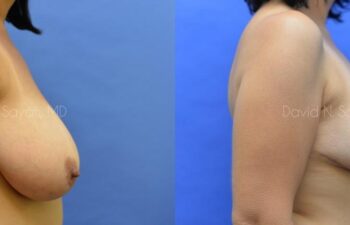 Breast Reduction Before and After | Sayah Institute