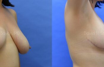Breast Reduction Before and After | Sayah Institute