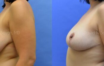Breast Reduction Before and After | Sayah Institute
