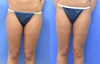 Liposuction Before and After | Sayah Institute