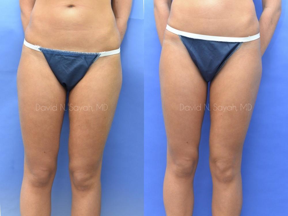 Liposuction Before and After | Sayah Institute